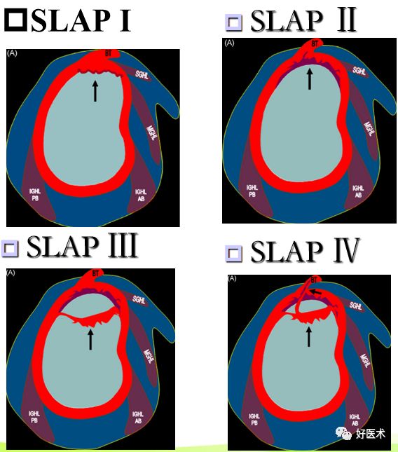 slap伴肱骨大结折节骨折bankart损伤bankart 损伤指盂唇前下方在前下