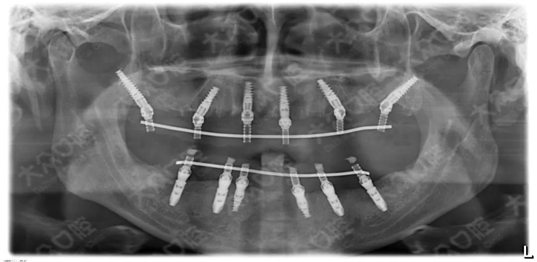 大众口腔成功开展高难度穿翼板viiv即刻种植即刻修复手术