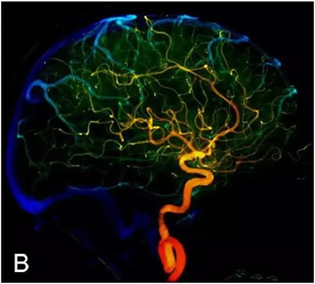 图3. 应用iflow研究缺血性脑血管病正常脑血管血流彩色全循环像a.