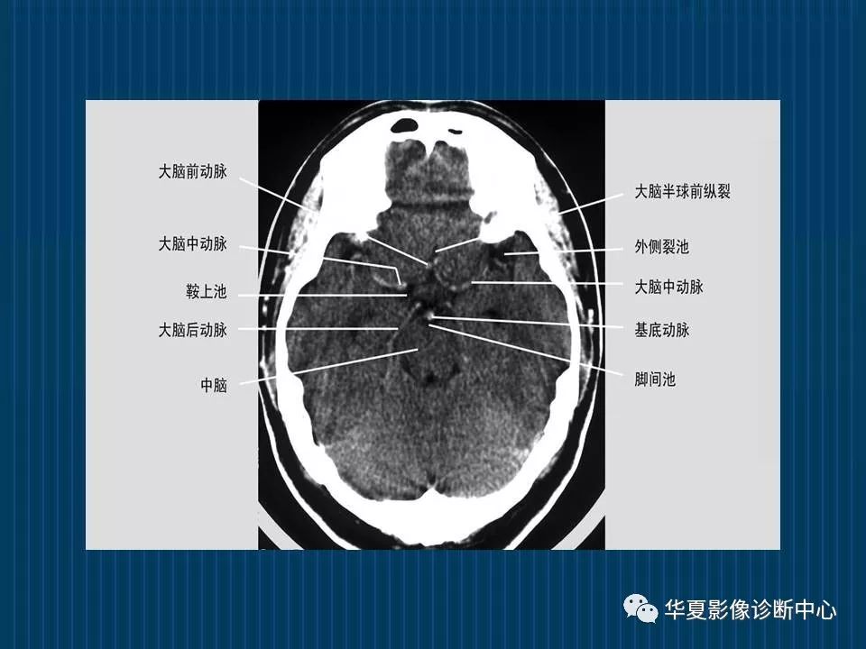 如何分辨ct与mri图像