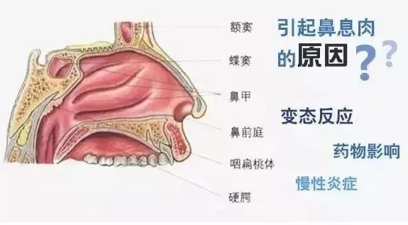 變態反應在鼻部多次發生,在組胺,白細胞三烯等化學介質作用下,鼻粘膜