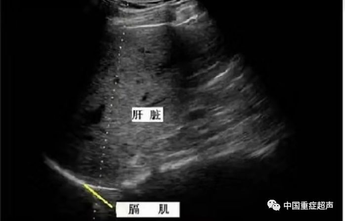 膈神经超声图图片