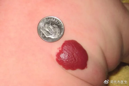 患上血管瘤,要注意什么 ? 4个方面都要管理好