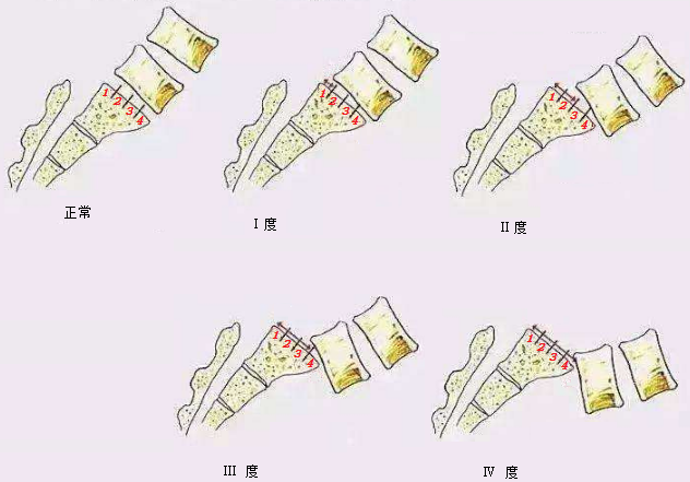 椎体滑脱分度详细图解图片