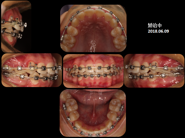 严重拥挤的安氏2类矫正