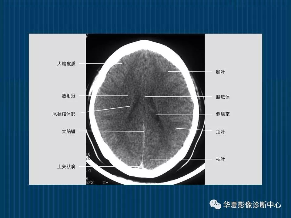 如何分辨ct与mri图像