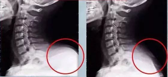 在使用了一个多月苗王追风液之后,原本凸起的大椎穴,在x光下也可以