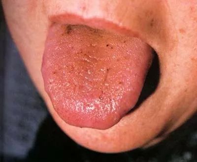 中医舌诊 | 红色齿痕舌薄黄干苔_边有齿