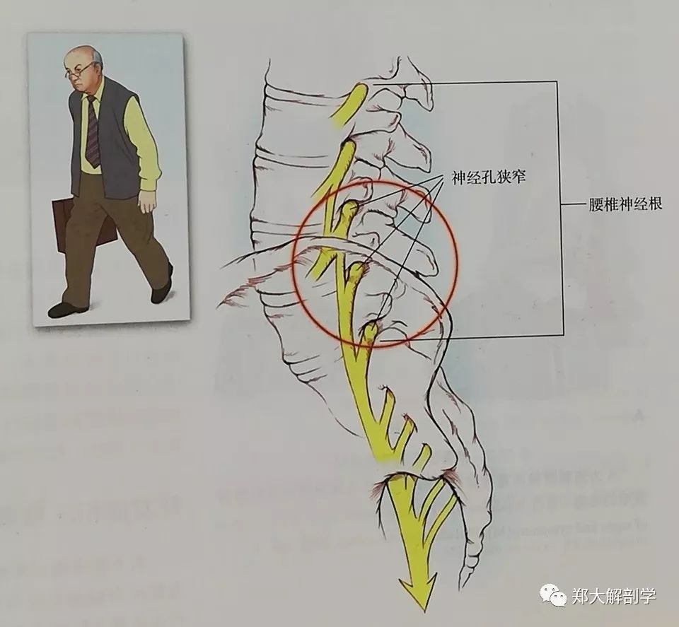 六種引起腰椎和骶髂關節的疼痛綜合徵