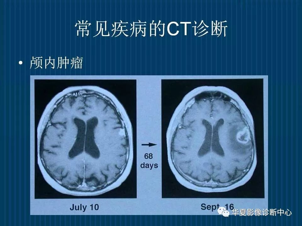 如何分辨ct与mri图像