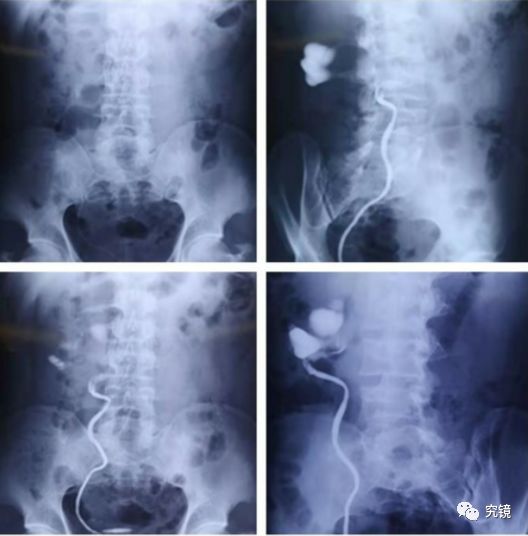 静脉尿路造影图片