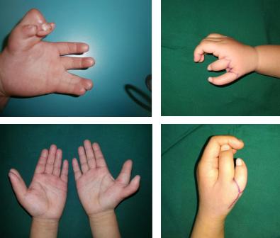 每一千个小孩中,就有一个患多指畸形_手术