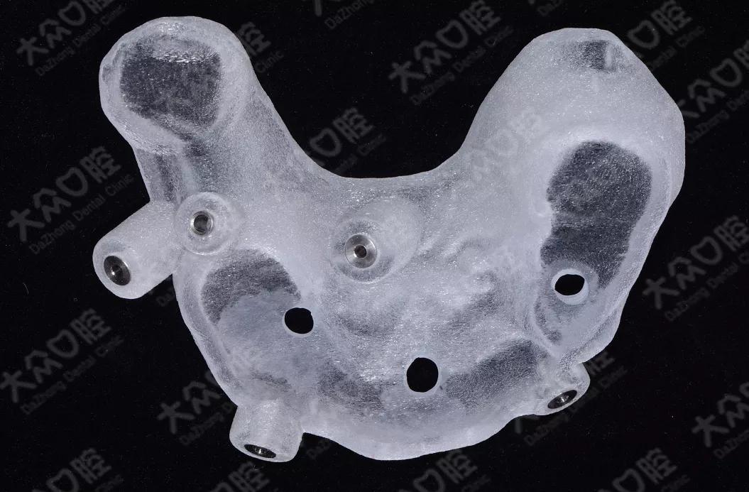 大众口腔成功开展高难度穿翼板viiv即刻种植即刻修复手术