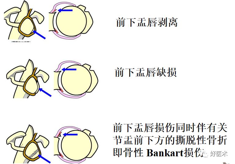 肩痛康复肩关节损伤影像诊断技巧