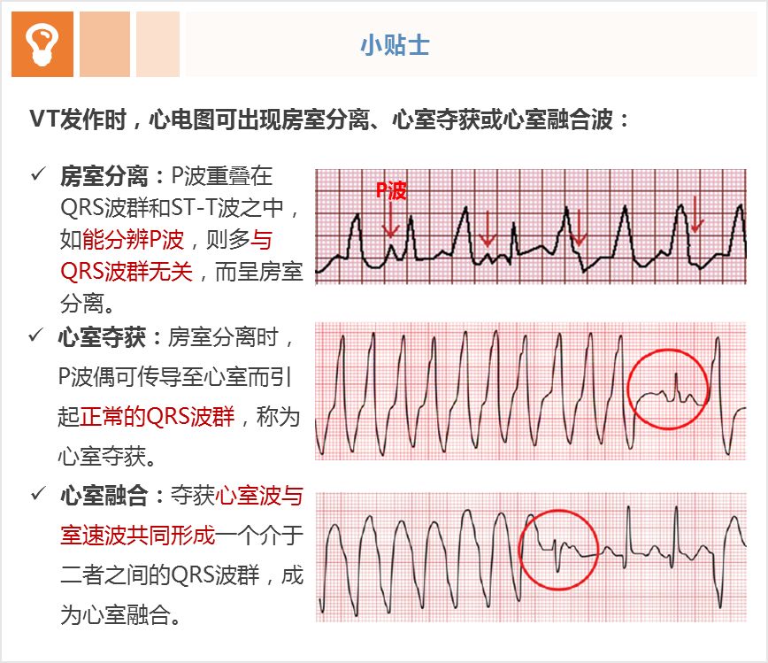 vt心电图典型特征为:qrs波群宽大畸形,st段和t波常融为一体不易分辨