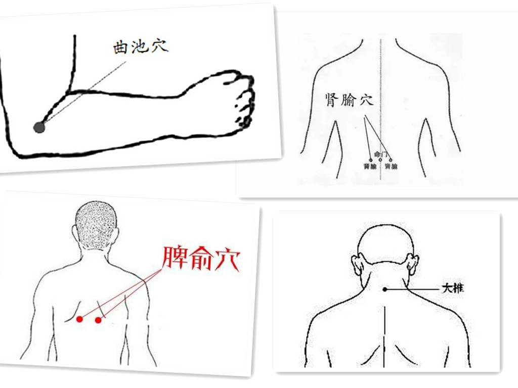 另外配穴是:病患在脊柱配夾脊;病患在上肢加天宗;下肢加秩邊;骶