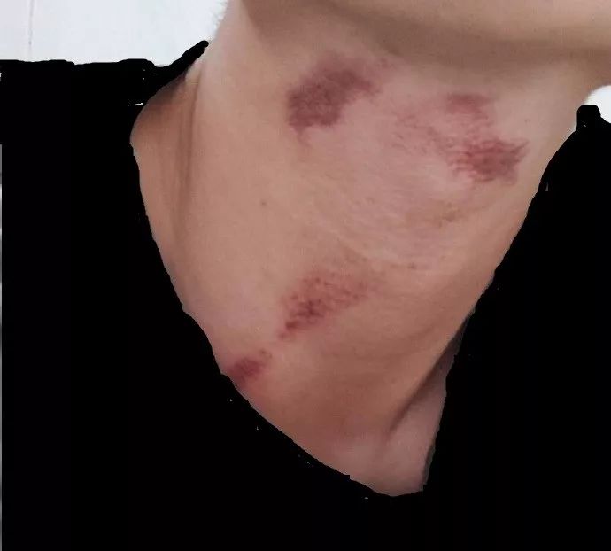 男朋友脖子上多了几个奇怪的吻痕他说那是刮痧
