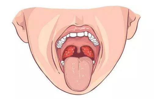 扁桃體請坐下你怎麼老愛發炎