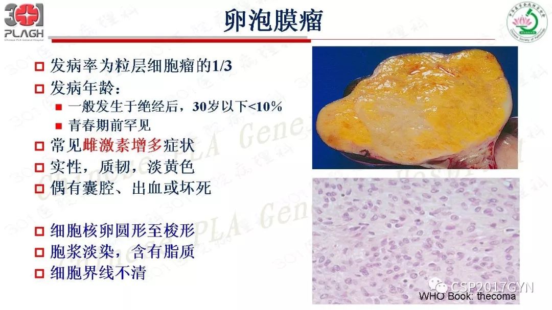 卵巢性索间质肿瘤病理学诊断及进展