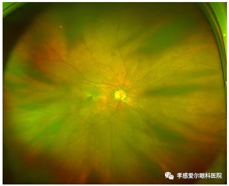 【好消息】欧堡超广角"免散瞳"眼底照相入驻孝感爱尔眼科,检查更方便