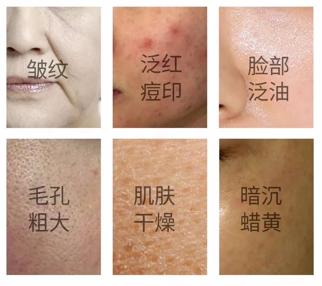 你必定会发生以下肌肤问题当脸部自由基过多,持续破坏细胞时赶不上"