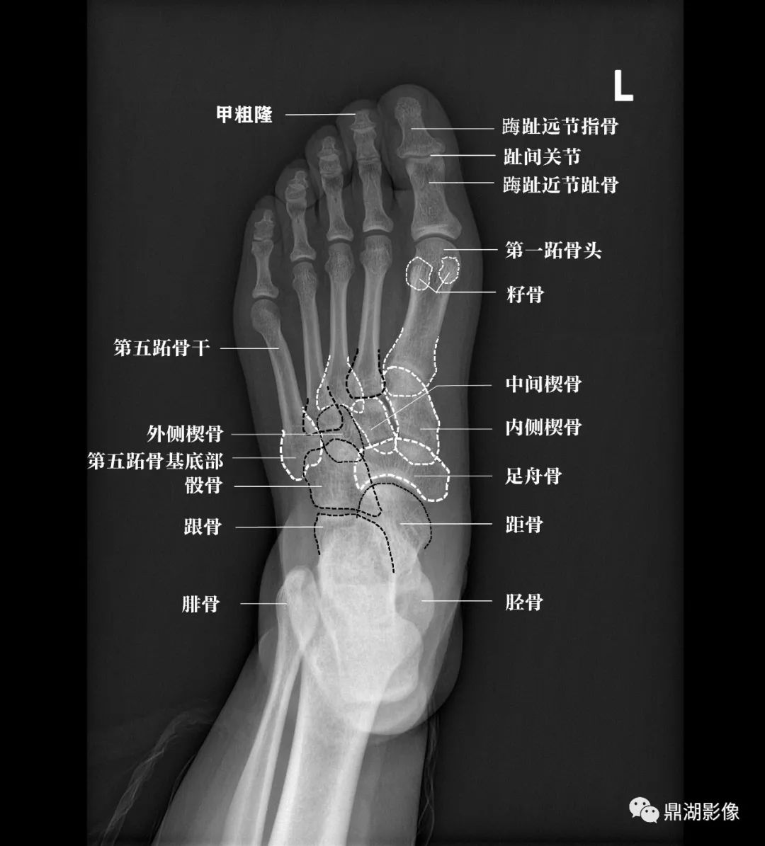 X线高清图谱 | 精致足部解剖_安健