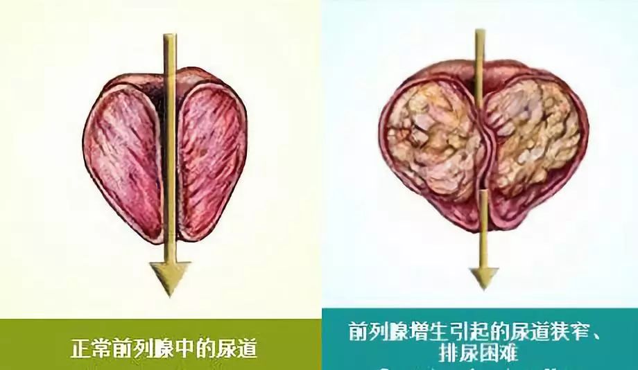 秋季前列腺问题高发,一招见效:对月经不调,宫寒,手脚冰凉同样有用!