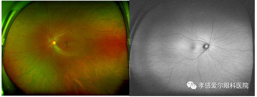 【好消息】欧堡超广角免散瞳眼底照相入驻孝感爱尔眼科,检查更方便