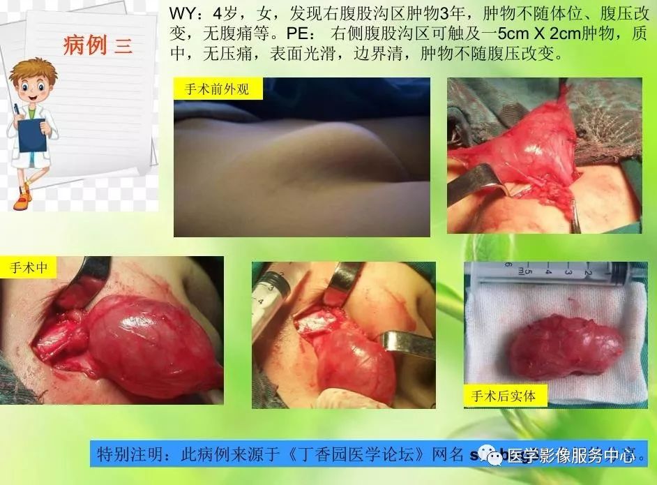 一例女性腹部包块,手把手教你如何在ct上做出病理诊断