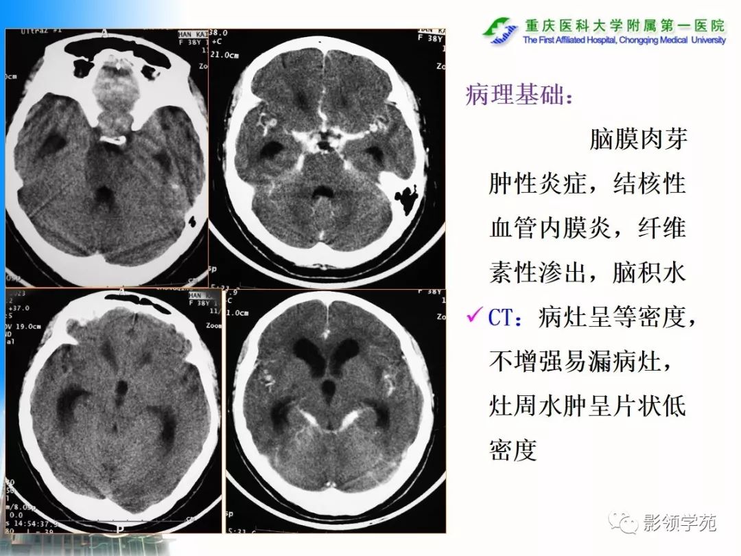 ⑤臨床感染背景:社區獲得性,術後或醫源性④病灶在腦內解剖分佈:幕上