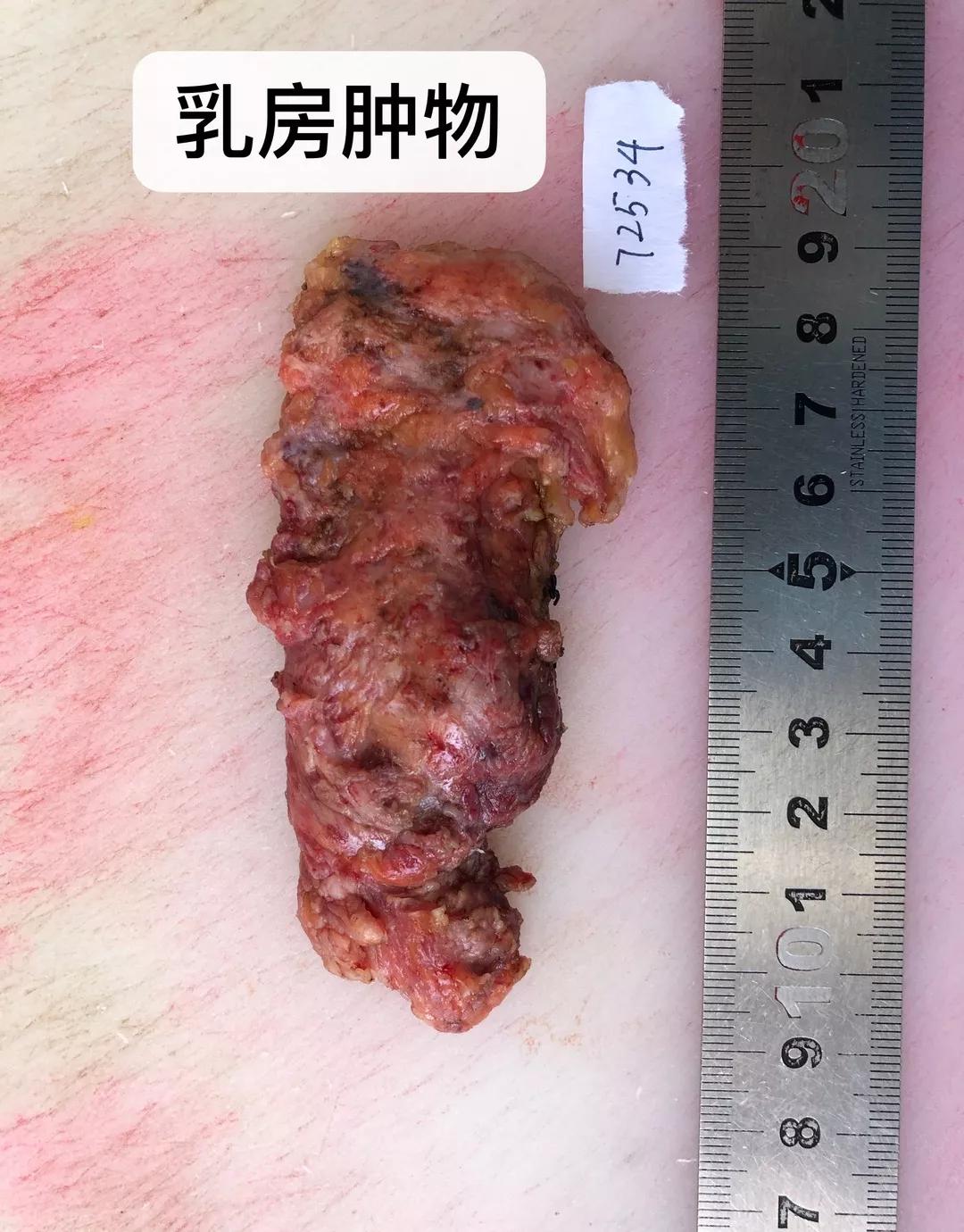 她只有13岁竟得了分泌性乳腺癌