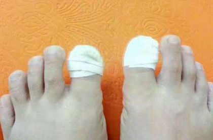 大名人必看的生活小妙招脚趾甲总是往肉里钻在家几毛钱就能简单解决