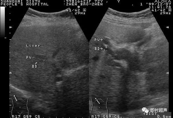 胆管癌超声图片