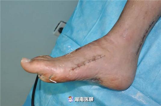 手术过程顺利,术后经过2个月的石膏外固定,小翰双足伤口愈合良好,足弓