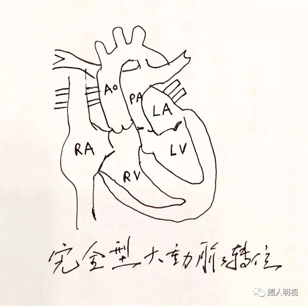 大动脉转位寥寥数语谈胎心之七
