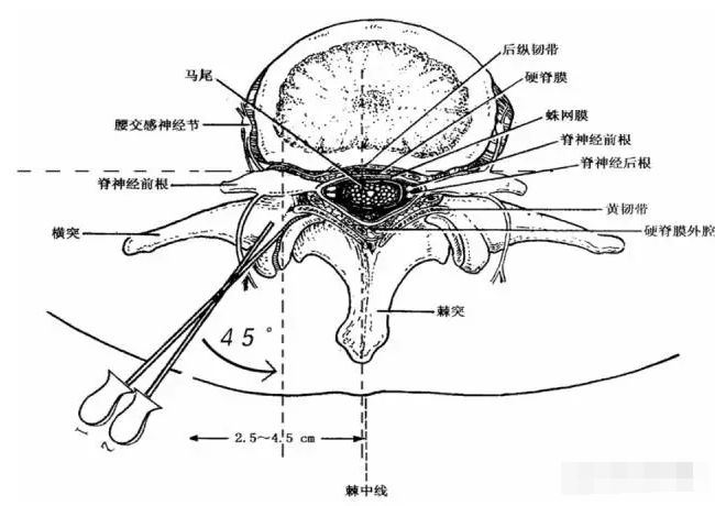 腰椎棘突在针刀定位治疗中的应用