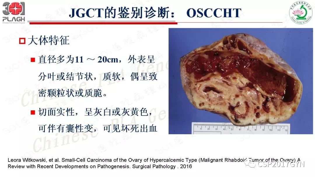 卵巢性索间质肿瘤病理学诊断及进展