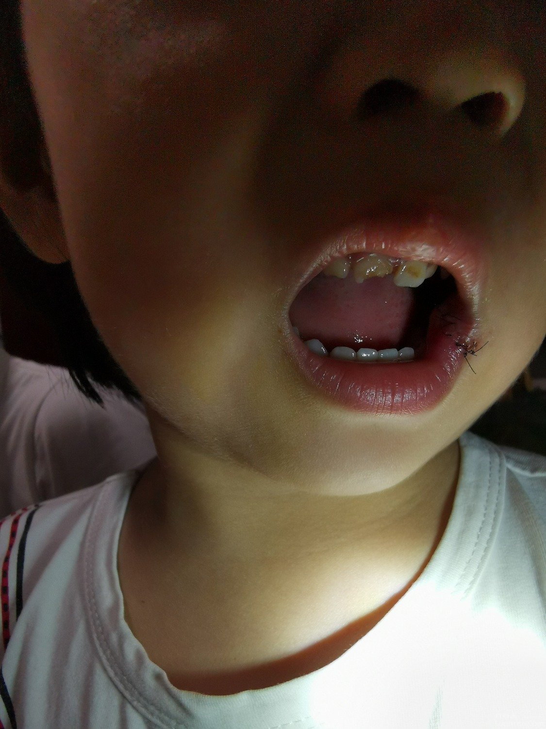 3岁的孩子在幼儿园才上3天学,嘴边缝了6针,门牙磕了半个
