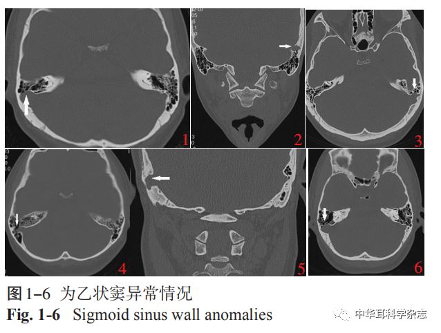 乙状窦骨壁缺损图片