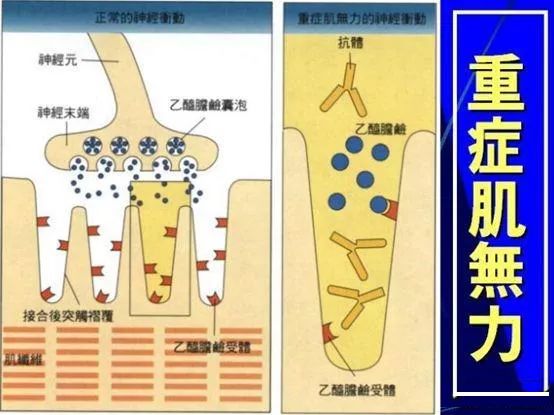 針對重症肌無力的病症,重症肌無力治療已經有了很多相應的方法措施