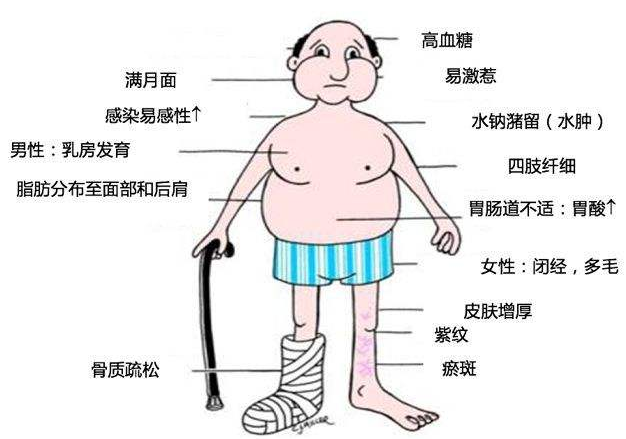 类风湿性关节炎长期吃激素药副作用到底有多大不只是简单的变胖