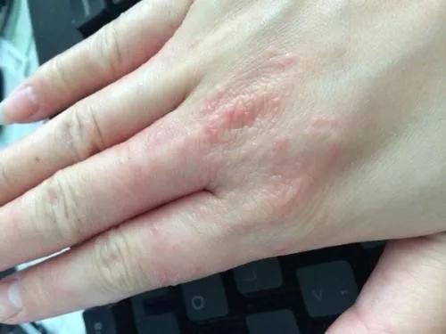 每个人接触到银杏酸都有可能产生过敏反应.