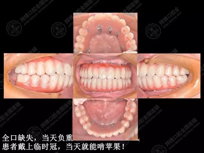 特别是作为目前种植牙领域的塔尖技术——穿颧/穿翼板种植,可以在上颌