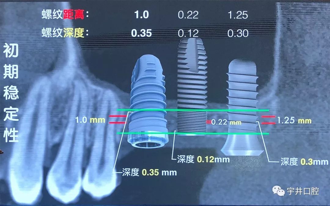 拓美种植体图片