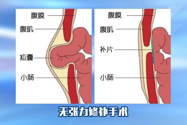 疝补片修补术图片