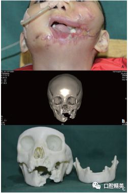 腓骨肌皮瓣修复6岁儿童创伤性口腔颌面部缺损:1例报告及文献复习