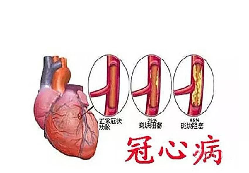 血栓形成等造成血流受阻,供血不足引起的心肌缺血性病变