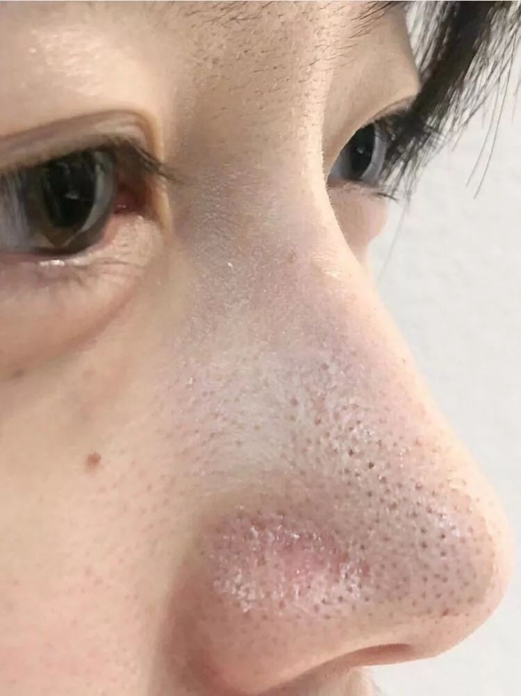 这样去黑头活该你的草莓鼻越来越严重用它10年黑头连根拔起堪比光子