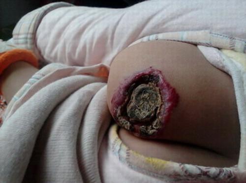 勤剪孩子指甲,预防血管瘤溃破!