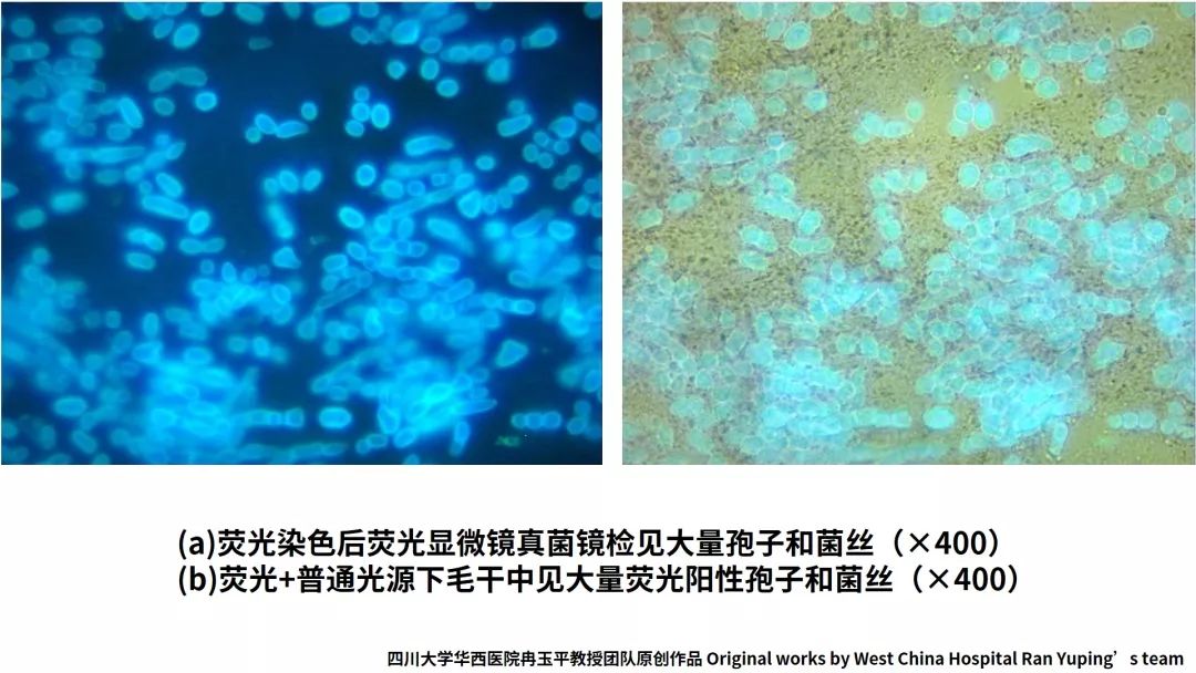 白癣毛发荧光染色后可见明显的真菌菌丝